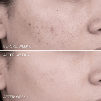 Acne Drying Lotion Plus (1.8% Encapsulated Salicylic Acid) — 20 mL