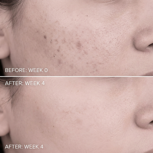 Acne Drying Lotion Plus (1.8% Encapsulated Salicylic Acid) — 20 mL